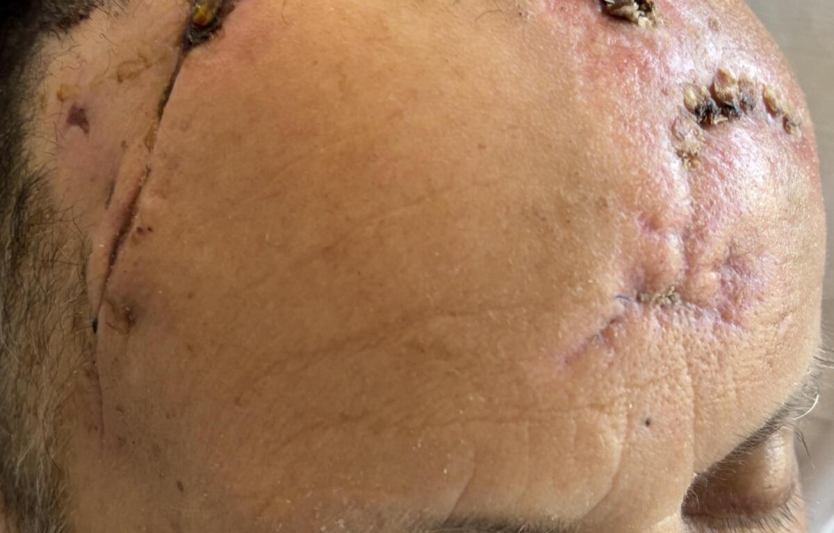 Don's skull is missing its skullcap. His head has red and black scaring near the skullcap area.