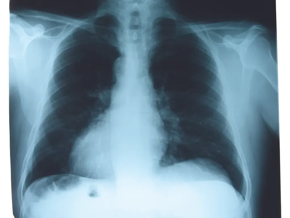 lung cancer x-ray