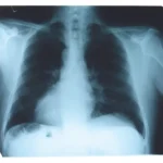 lung cancer x-ray