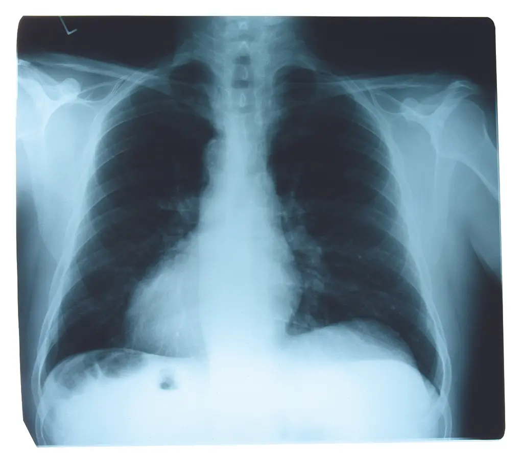 lung cancer x-ray